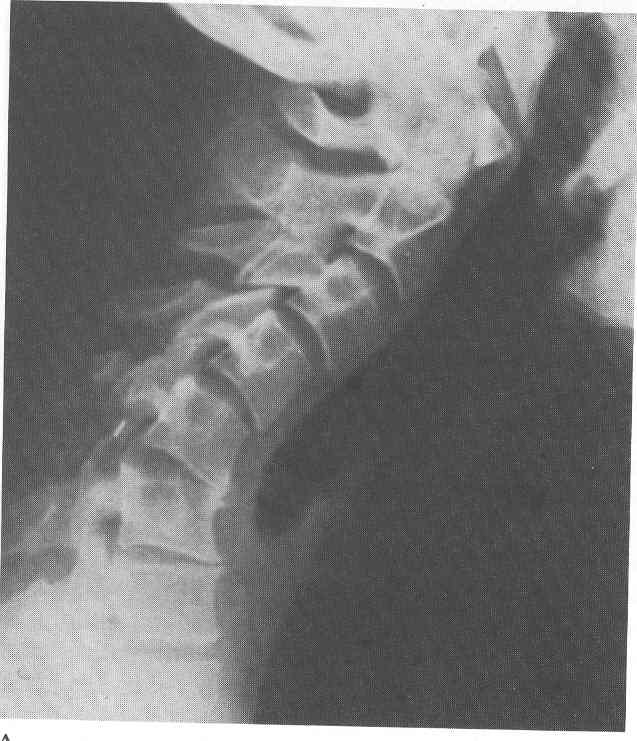 Eliminazione di operazione di ernie intervertebrali